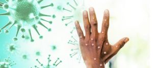 CTP Sağlık Komitesi’nden M çiçeği virüsüne karşı acil hazırlık çağrısı